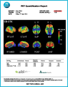 The image is of a PET Quantification Report which shows brain scan images in colour and and a written report interpreting the scansof the scans