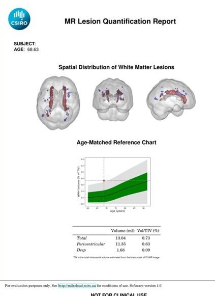 Image of an MR Lesion Quantification Report. It shows brain scans revealing the spatial distribution of white matter lesions, for a 68 year old patient, with an aged-matched reference chart.