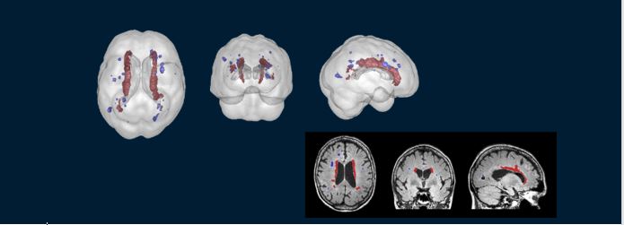 Images of brain scans showing white matter lesions