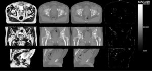 An image representing a scan showing prostate cancer in a patient. From left to right they represent : sample patient MRI, CSIRO generated CT, actual planning CT, and the difference.