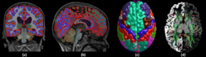 An image of 4 different aspects of the brain recorded through advanced neuroimaging techniques