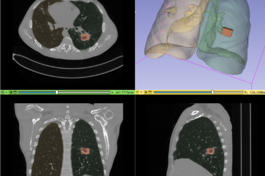 CT image of a lung in patient with tuberculosis